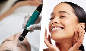 Full Face Microneedling Session at La Glace Brackenfell
